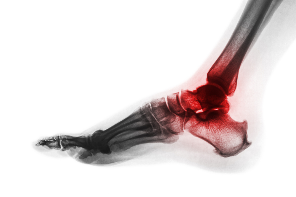 arthritis ankle