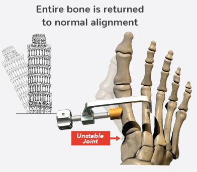 lapiplasty procedure