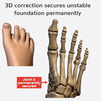 lapiplasty procedure