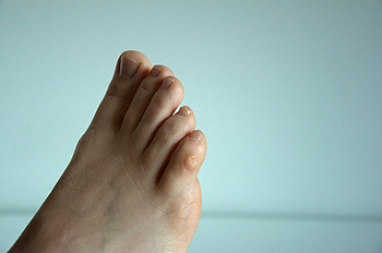 Foot Surgery: Neuroma or Plantar Callus