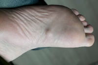 Understanding Plantar Fibromatosis