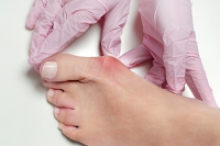 Risk Factors for Bunions