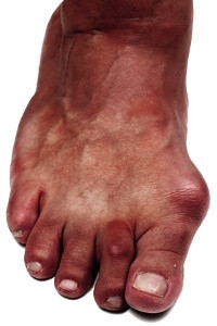 Wearing Shoes That Fit Poorly May Cause Bunions to Become Worse