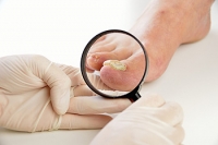 Is Laser Treatment an Effective Way to Treat Toenail Fungus?