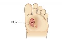 Finding Relief From Foot Ulcers