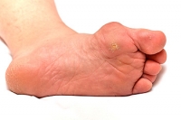 Causes and Treatment Options for Bunions