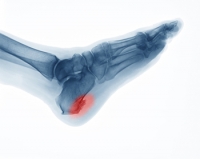 Definition and Symptoms of Heel Spurs