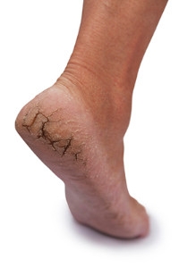 Can Cracked Heels Be Prevented?