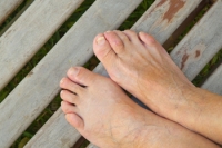 Hammertoe May Be Preceded by a Bunion