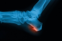 Causes of Bone Spurs on the Feet