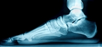 Can Flat Feet Be Inherited?