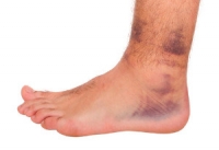 Facts About Ankle Sprains