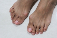 Symptoms and Treatment of Bunions